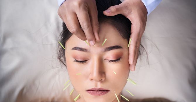 Traditional Acupuncture